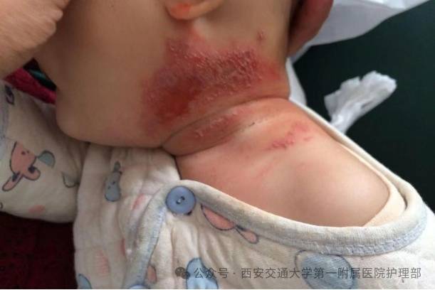 皇冠信用盘_西安多区发现隐翅虫?千万别拍皇冠信用盘!毒液堪比硫酸